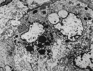 M,61y. | spleen - hemangioma v.s. … erythrophagocytosis